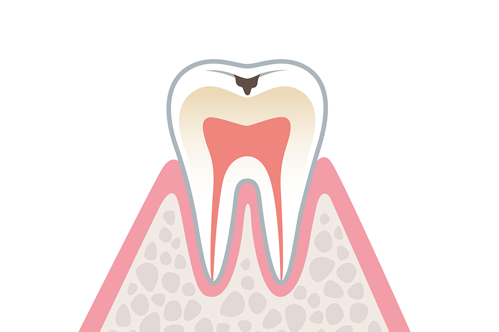C1:エナメル質のむし歯