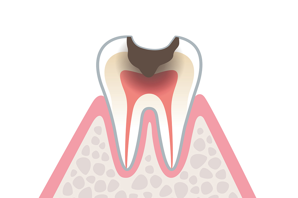 C3：歯の神経まで達したむし歯