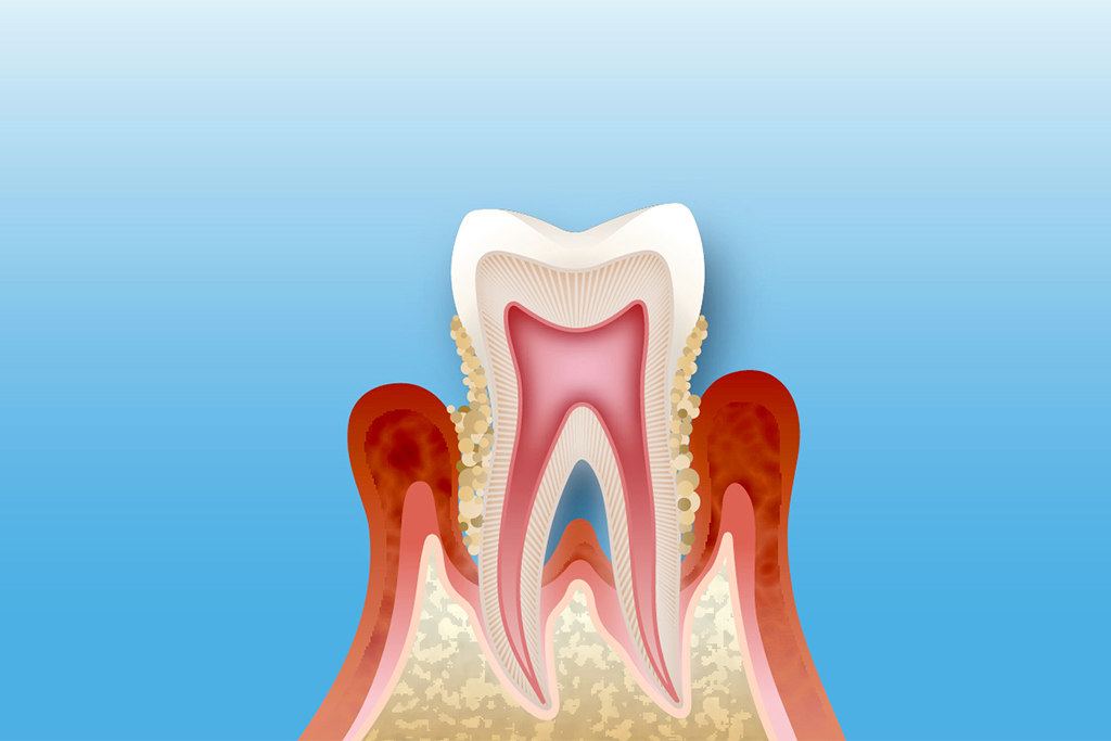 “歯周病が手遅れにならないうちに” 全身に影響がある歯周病の症状と治療について